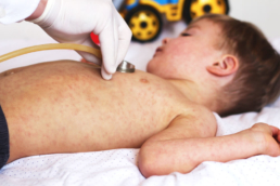 um bebê com sintomas do sarampo sendo examinado por um médico
