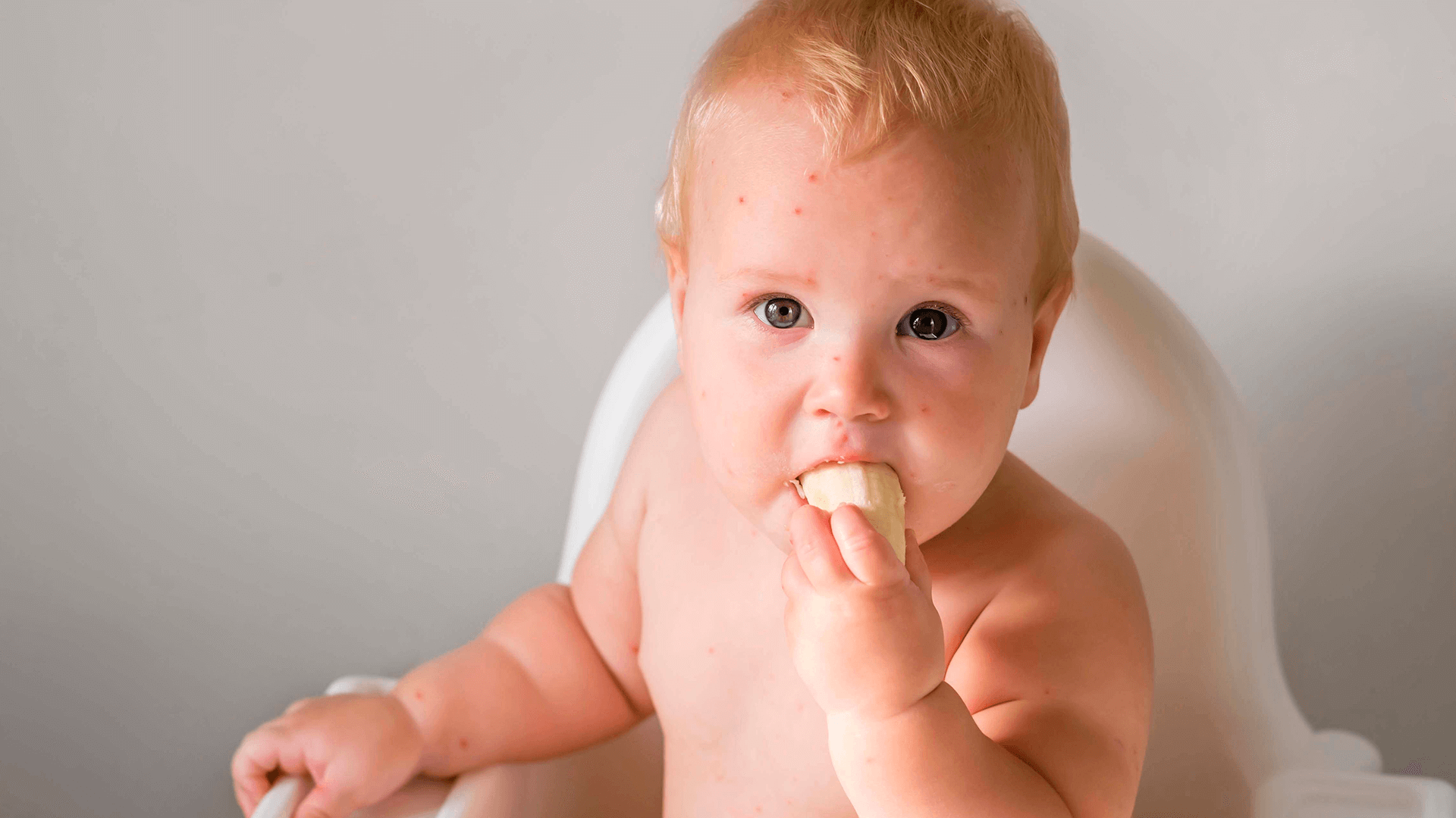 Um bebê com alergia na testa comendo uma banana