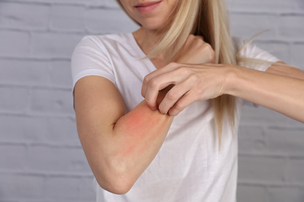 Mulher loira mostra o braço vermelho que resultou da coceira, um dos sintomas da alergia a medicamentos. 