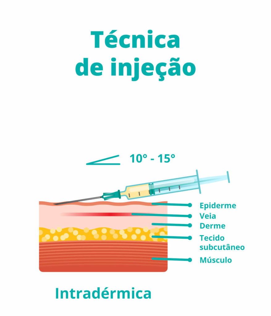 ilustração mostrando como é a aplicação da injeção intradérmica - beep saúde