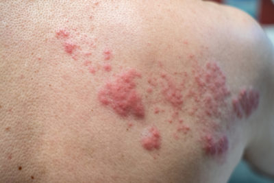 A imagem mostra a pele repleta de pequenas bolhas (chamadas de vesículas) para mostrar o que é cobreiro e seus sintomas. 