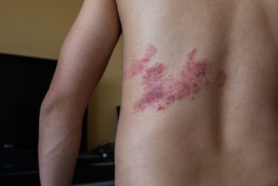 Pessoa de costas mostrando um dos sintomas da doença: pequenas bolhas avermelhadas., que representam o que é cobreiro.