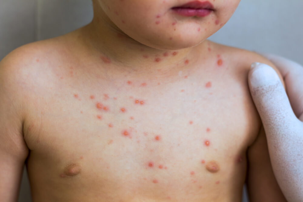 Criança pequena com bolhas (vesículas) características da doença, que representam o que é varicela.