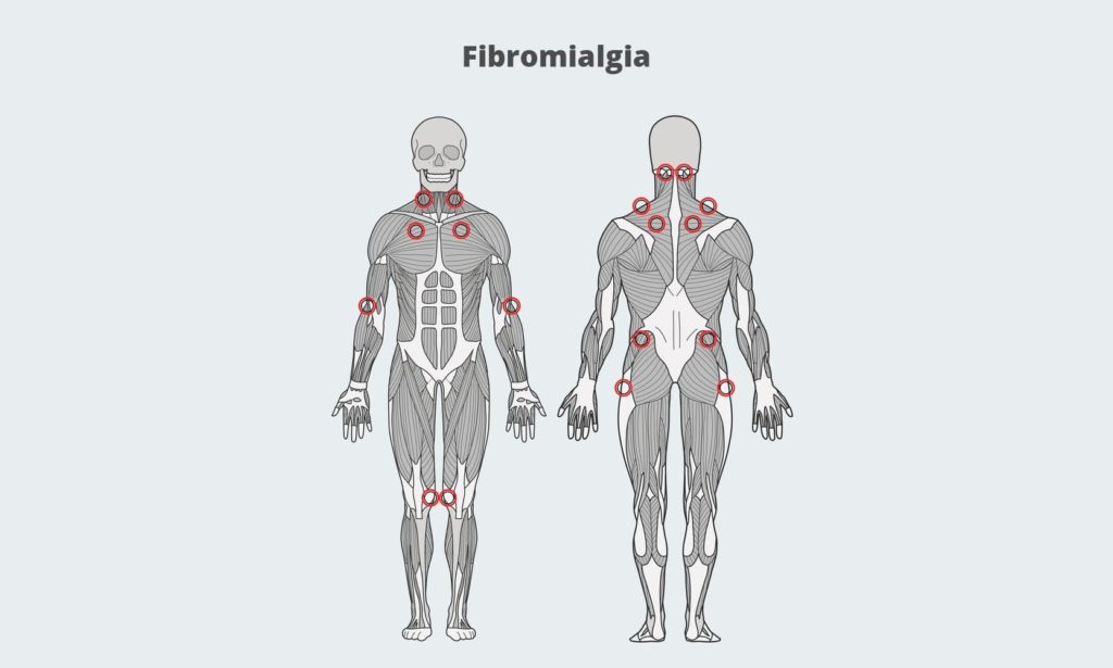 ilustração do corpo humano mostrando os pontos de onde ocorre a fibromialgia