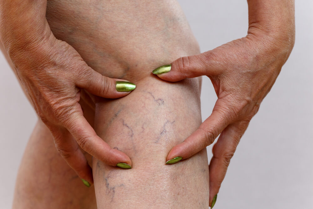 Imagem mostra as mãos de uma mulher mostrando as varizes na perna, mostrando o que é trombose