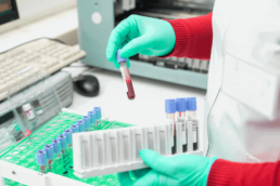 Mostra uma pessoa segurando várias ampolas de sangue que são dosagens para o exame fan