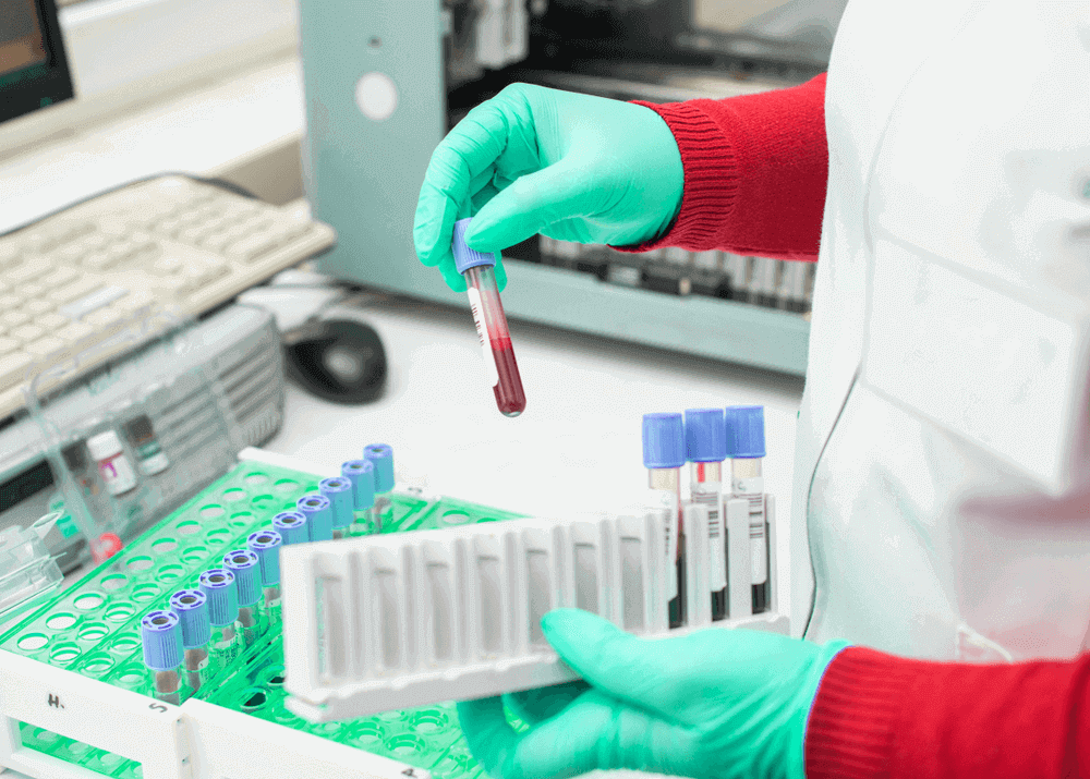 Mostra uma pessoa segurando várias ampolas de sangue que são dosagens para o exame fan