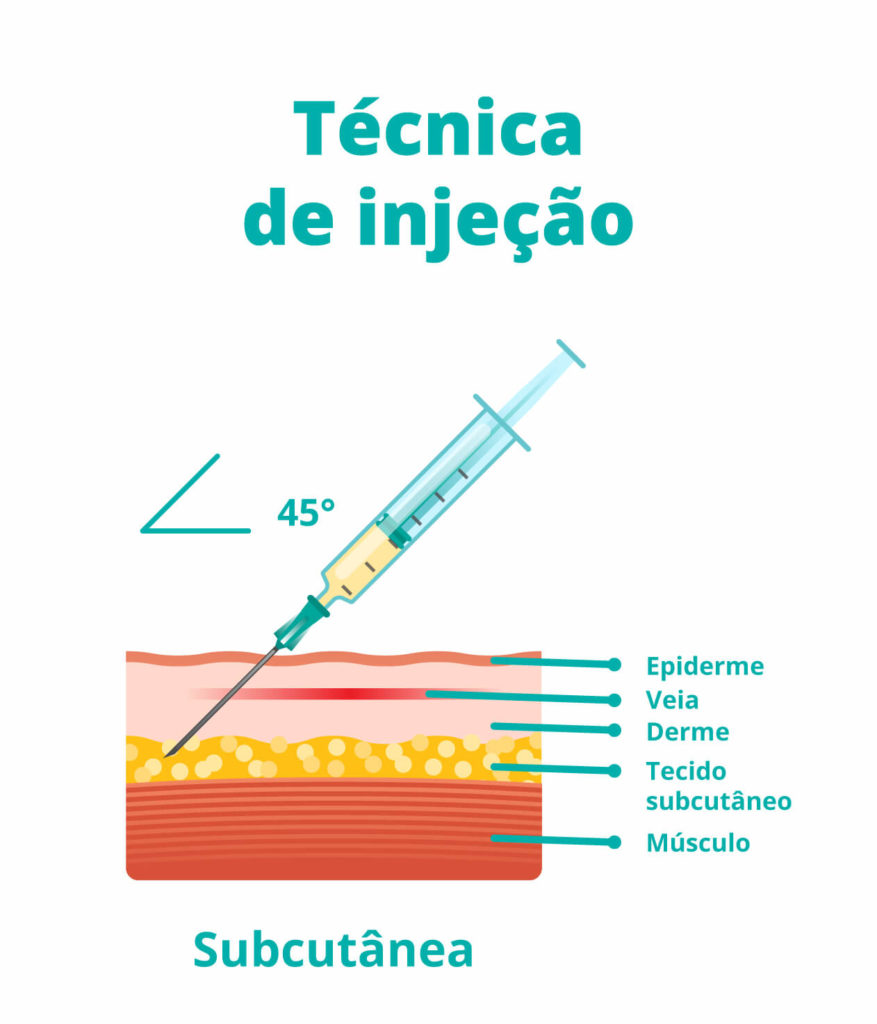 ilustração mostrando como funciona a técnica de injeção subcutânea, usada na vacina tríplice viral