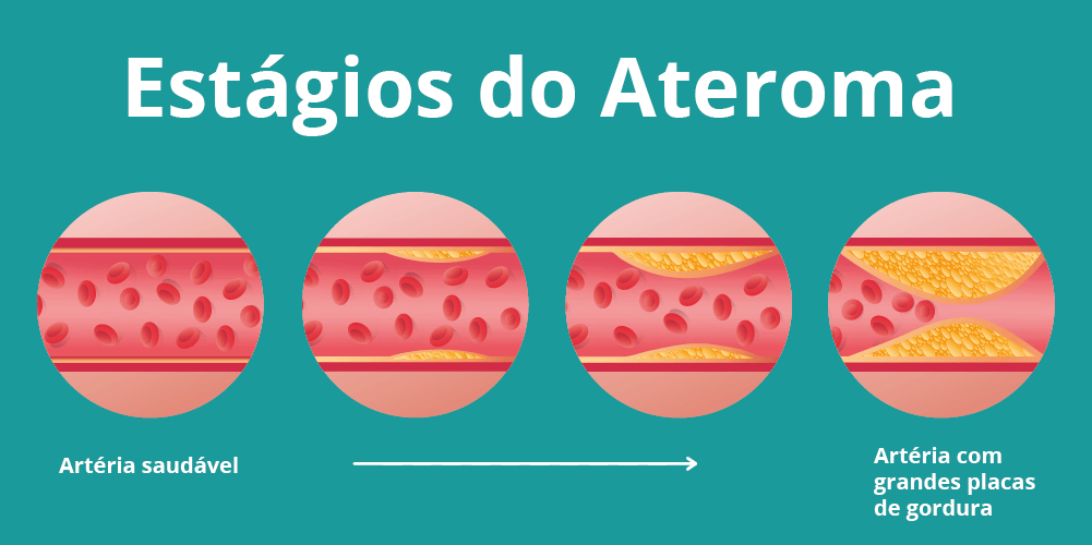 Ilustração mostra os estágios do ateroma (placas de gordura nas artérias). Na primeira bolinha está uma artéria saudável e as três bolinhas seguintes mostram a evolução do acúmulo de "colesterol ruim", causando as placas de aterosclerose.