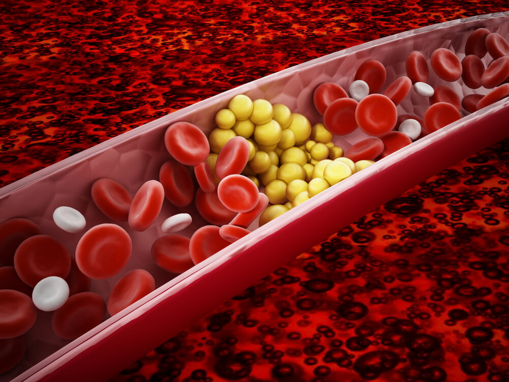 Ilustração mostra uma artéria bloqueada por colesterol. O que acontece quando o LDL "colesterol ruim" está em excesso no nosso sangue.