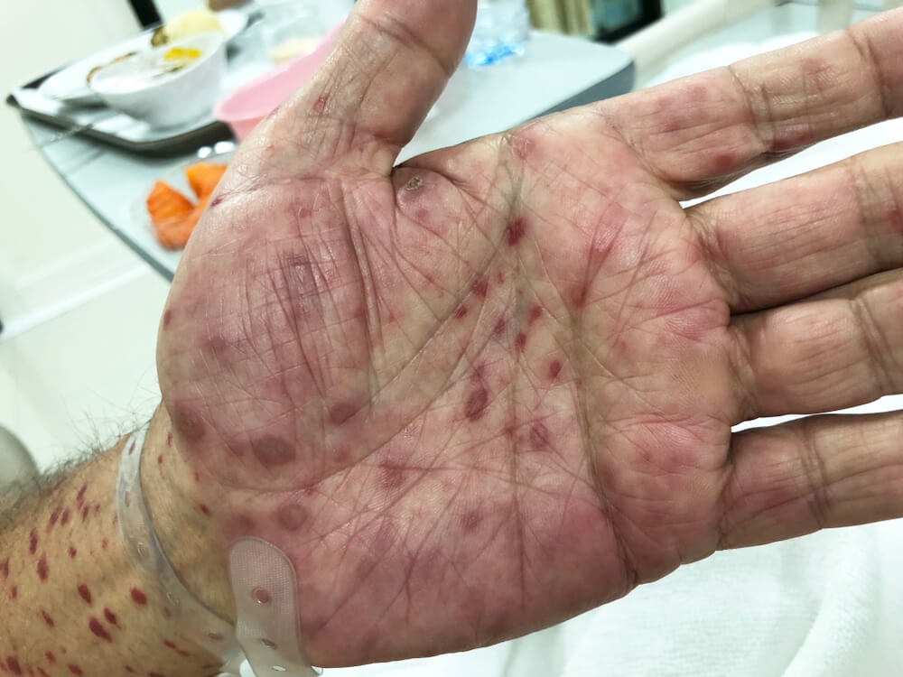 Imagem mostra a palma de uma mão com sinais de sífilis, diversas manchas vermelhas