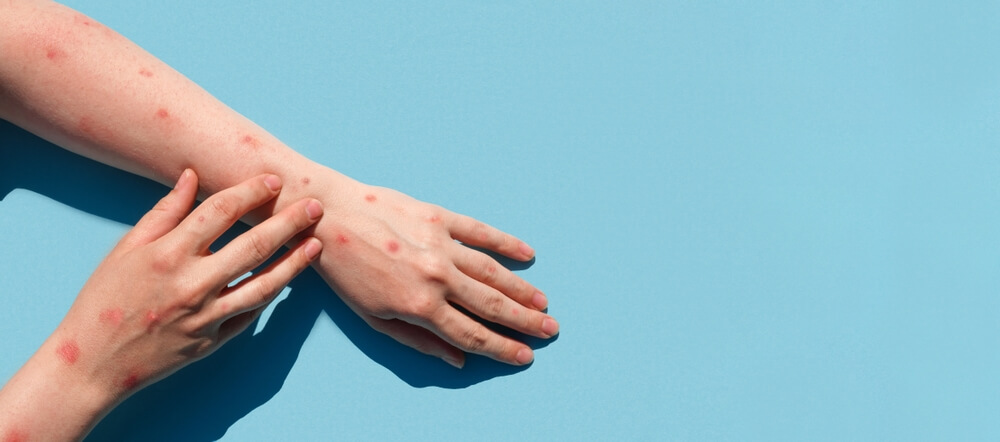 Mãos e braços contaminados pela varíola do macaco