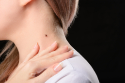 Mulher com um carrapato no pescoço que pode transmitir a febre maculosa.